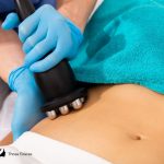 radio frequency skin tightening on the stomach