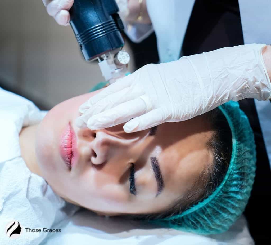 lady getting Microneedle Radiofrequency treatment