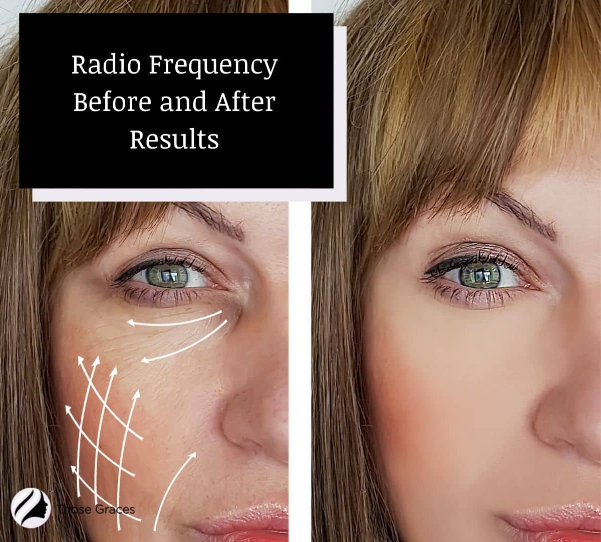 Radio Frequency Before and After results photo