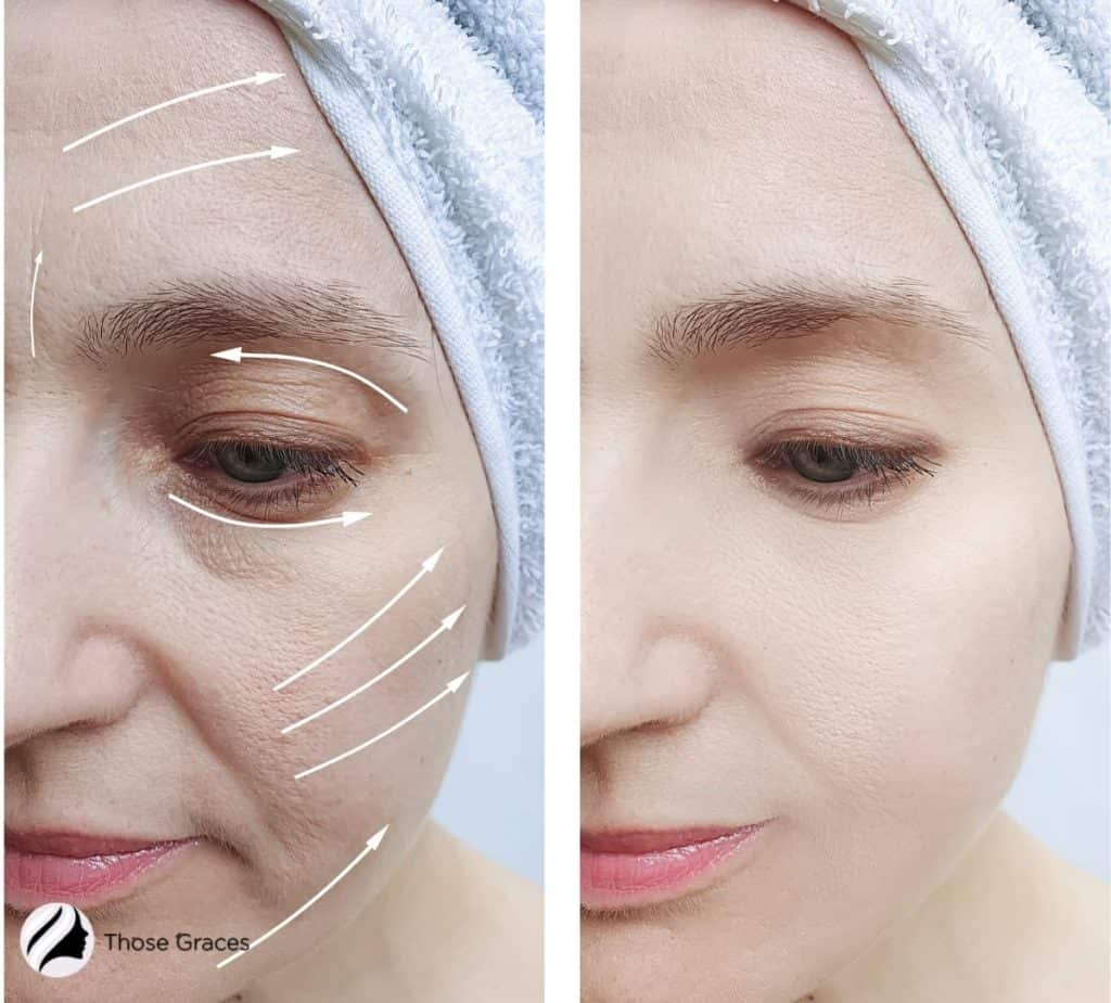 photo of rf skin tightening before and after