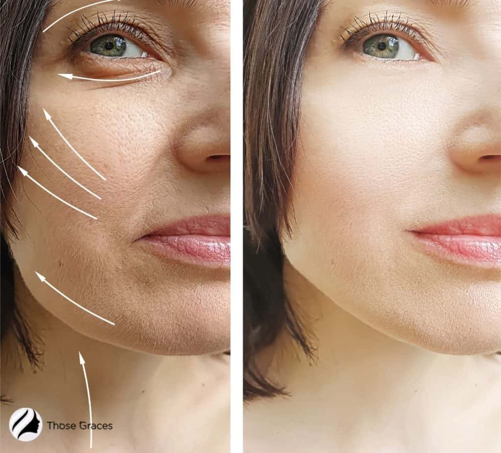 Radio Frequency Before and After of a woman with healthier skin