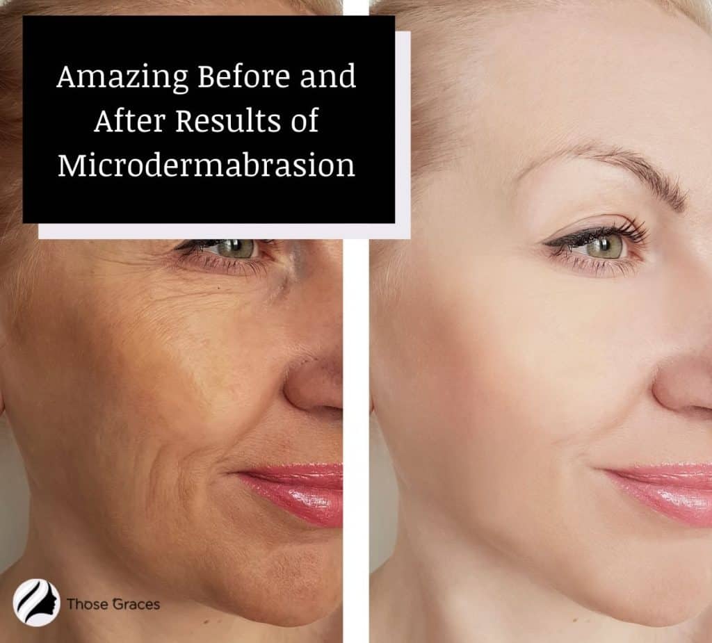 5 Amazing Before and After Results of Microdermabrasion – ThoseGraces.com