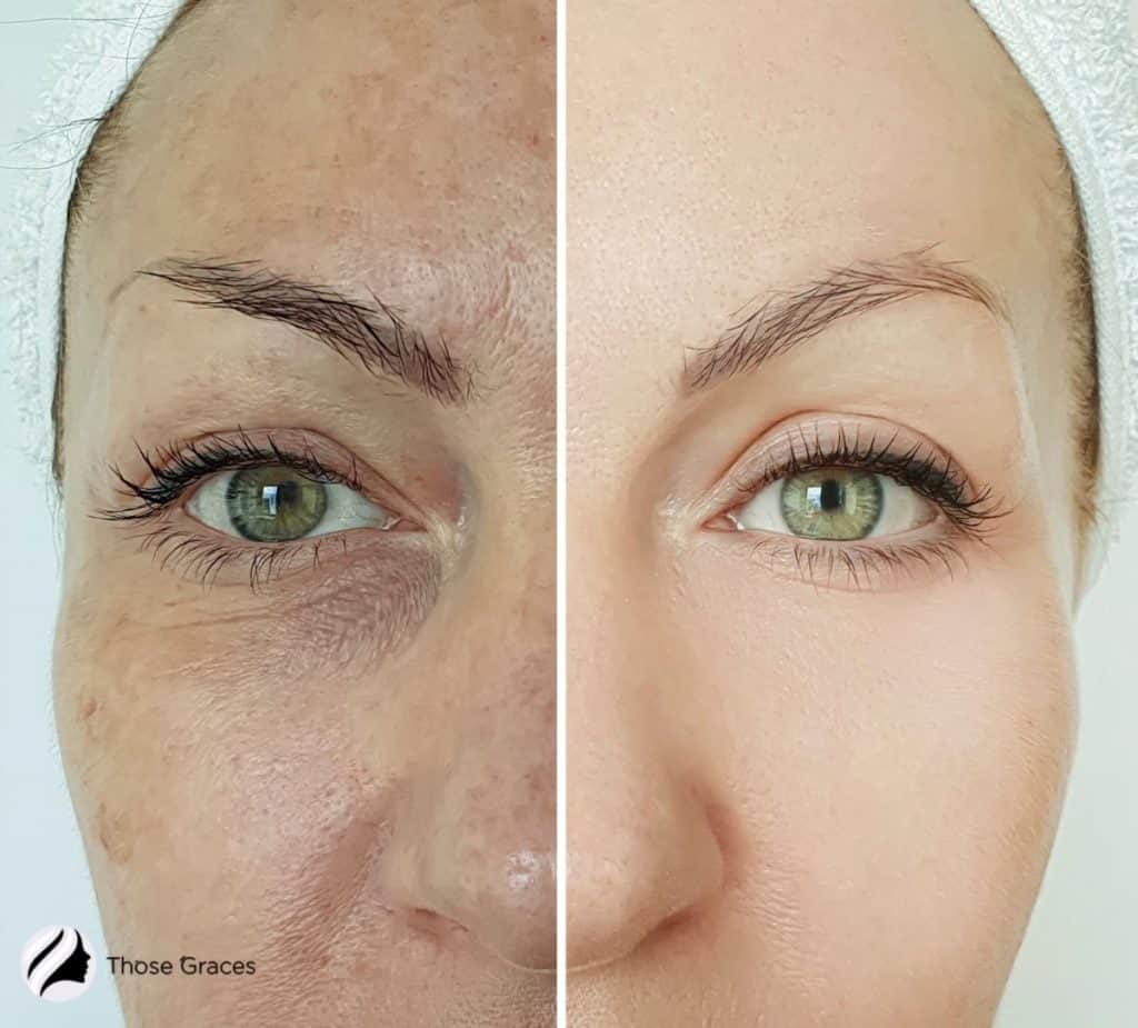 amazing before and after microdermabrasion reults