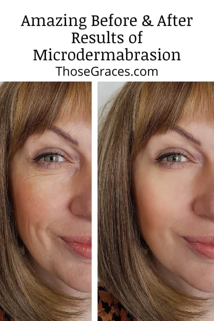 incredible results of before and after microdermabrasion