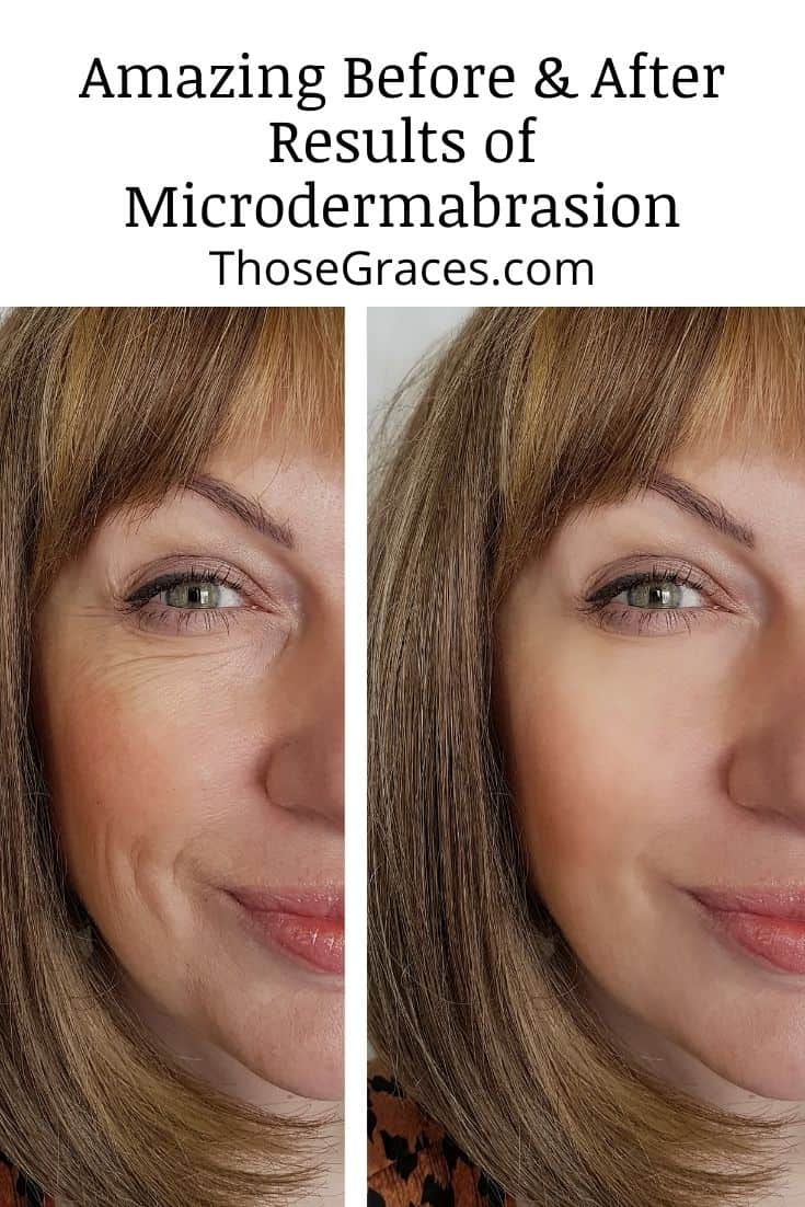 5 Amazing Before And After Results Of Microdermabrasion – ThoseGraces.com