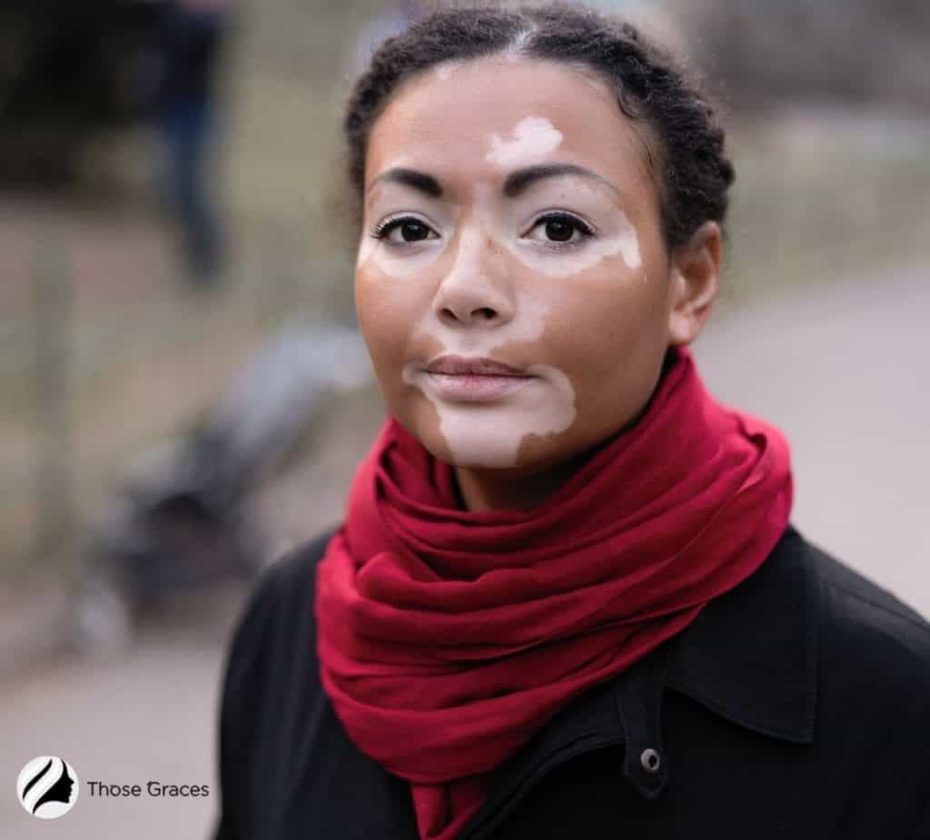 vitiligo pasty skin tone