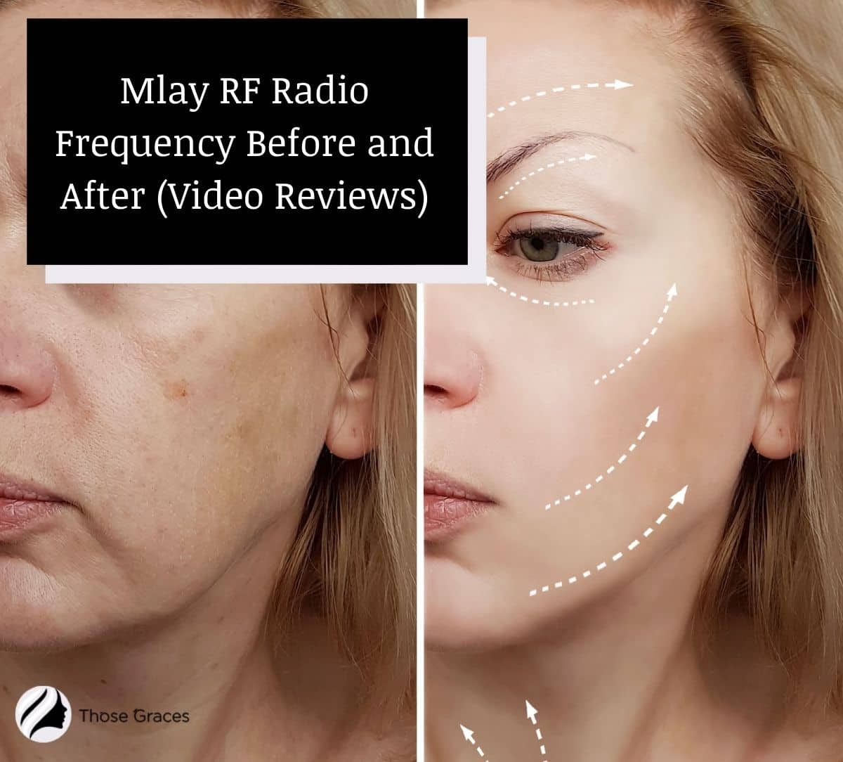 mlay rf radio frequency before and after photo of a lady