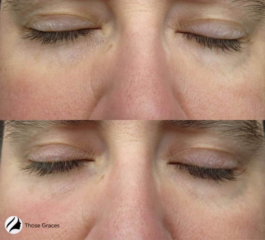 before and after photo of the lady's face after using solawave facial wand