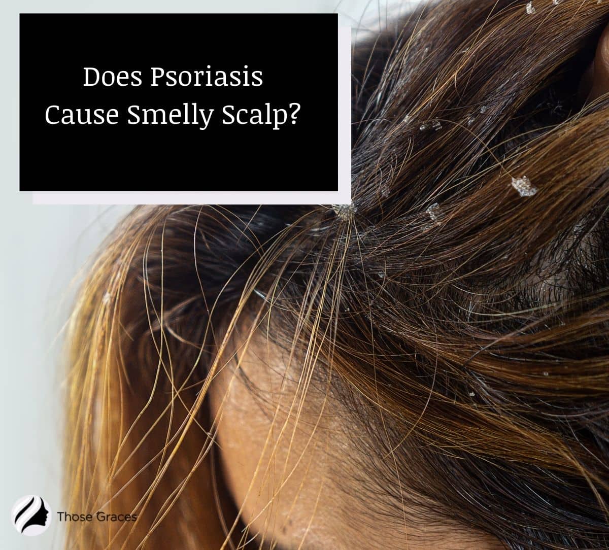 lady with psoriasis but how does scalp psoriasis smell?