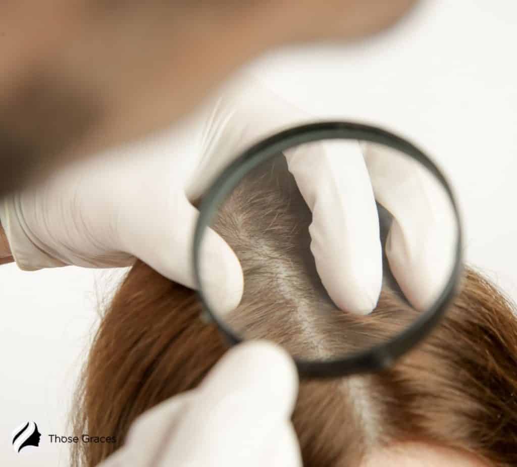 lady inspecting the scalp of a woman