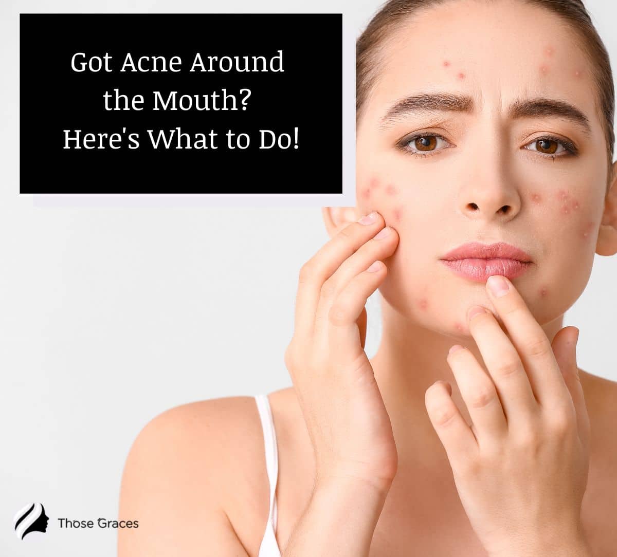 woman Suffering From Acne Around The Mouth