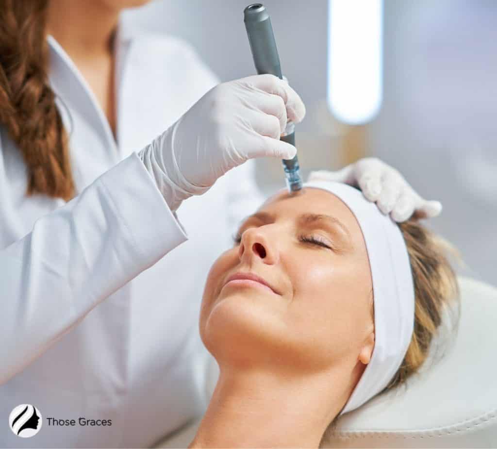 lady having a microneedling session