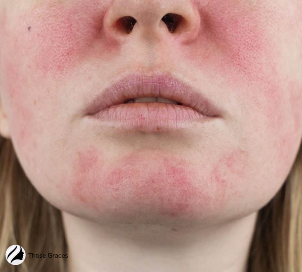 face with redness after microneedling
