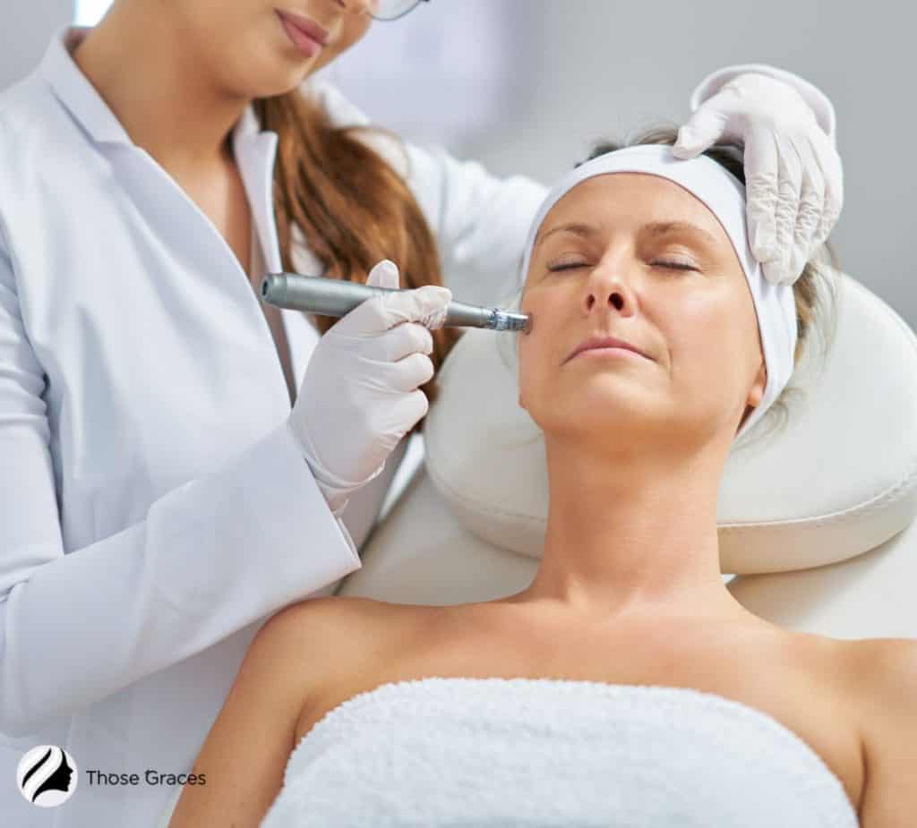 lady having a microneedling session