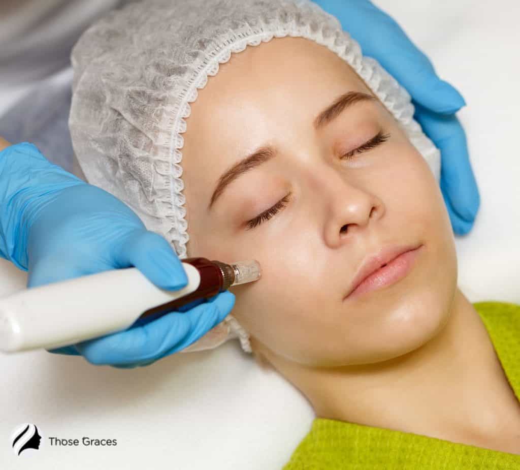 lady having a microneedling session