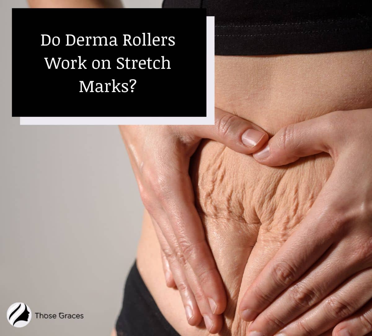 lady showing her stretch marks on the belly but Do Derma Rollers Really Work on Stretch Marks?