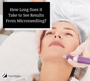 How Long for Microneedling Results? Doctor Reveals Timeline ...