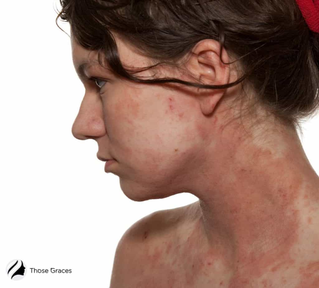 Lady with Eczema